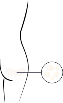 cellulite metabolizes