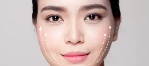 A woman’s face showing results of a PDO face thread lift